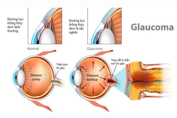 Thiên đầu thống là tình trạng tăng nhãn áp, xảy ra khi áp lực trong mắt tăng cao