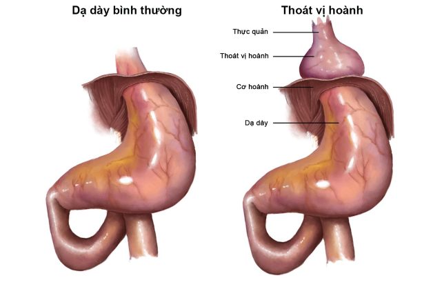 Thoát vị hoành gây trào ngược dạ dày thực quản