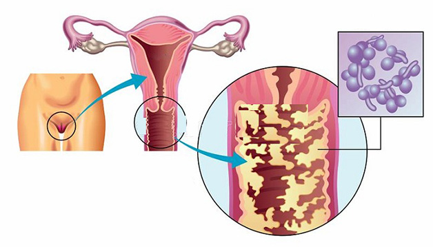 Viêm âm đạo có thể xuất phát từ nhiều tác nhân, thể hiện qua nhiều triệu chứng khác nhau