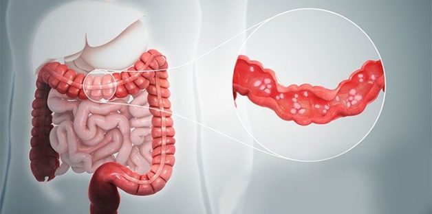 Đoạn đại tràng bị viêm cấp tính