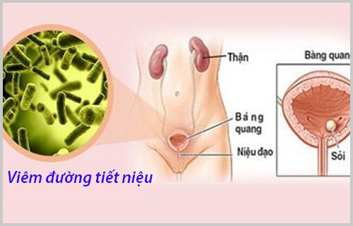 quy trình tán sỏi bàng quang