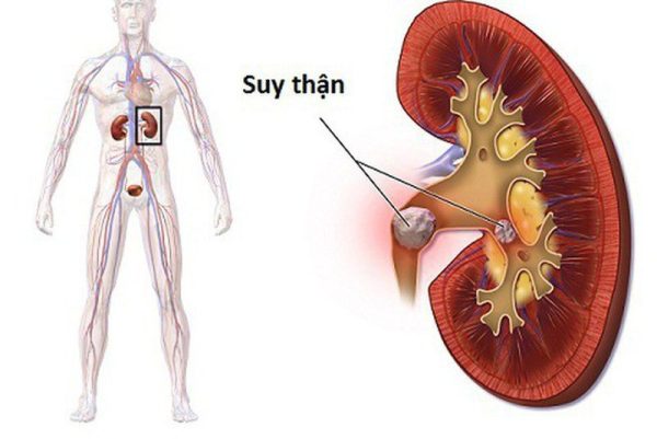 phương pháp điều trị sỏi niệu quản
