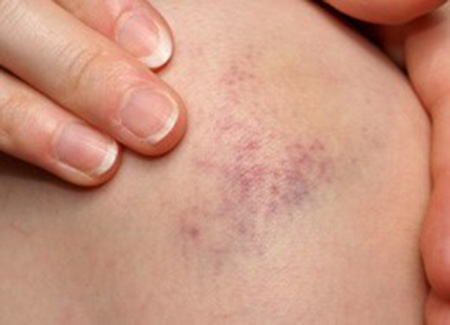 Xuất hiện vết bầm tím nhẹ sau khi tán sỏi ngoài cơ thể