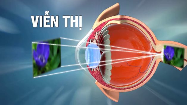 bệnh viễn thị