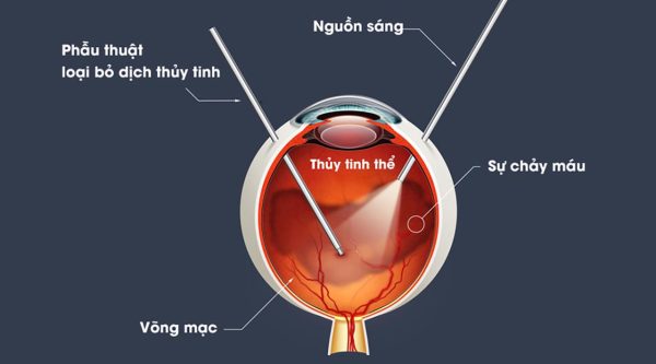Bị xuất huyết dịch kính mắt
