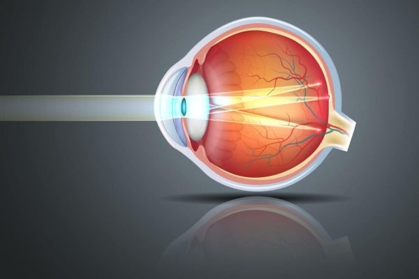 Khúc xạ xảy ra khi mắt không thể hội tụ đúng hình ảnh trên võng mạc