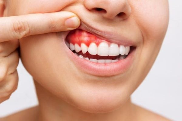 Người bị viêm lợi thường có phần nướu sưng tấy, dễ chảy máu, có dịch mủ bất thường...
