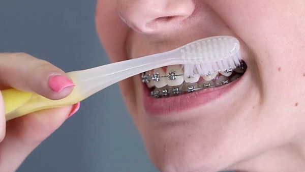 chăm sóc răng khi niềng