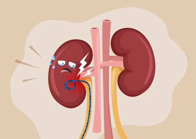 Những đối tượng được chỉ định đặt ống sonde JJ niệu quản