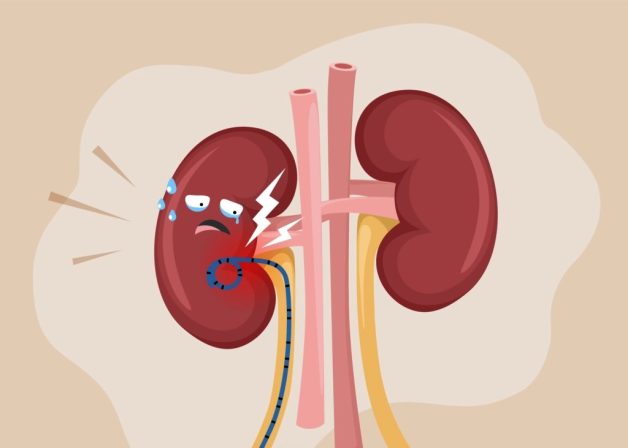 Đau sau tán sỏi niệu quản nội soi ngược dòng và phương hướng xử lý