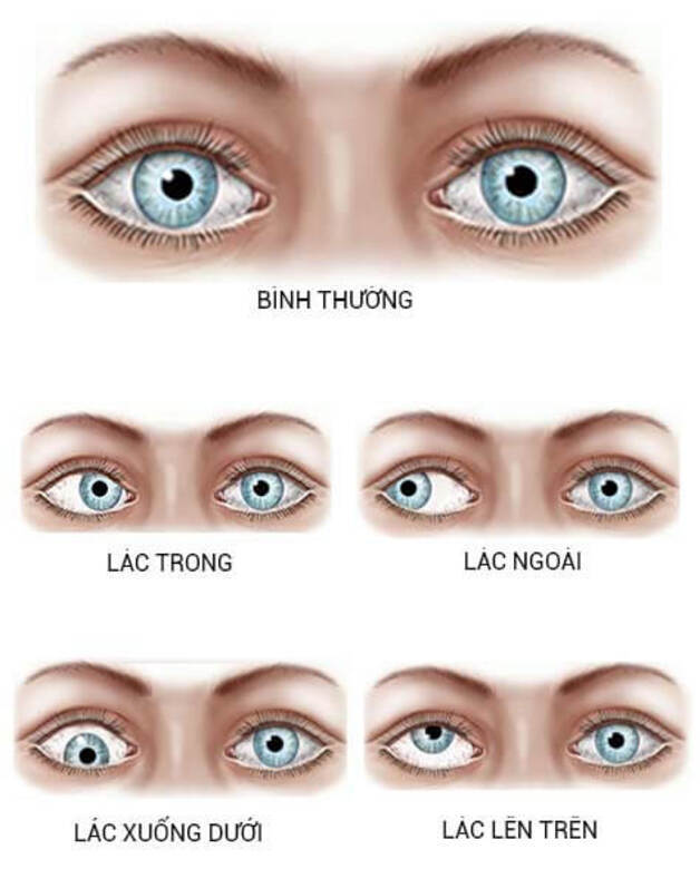 cách trị mắt lé