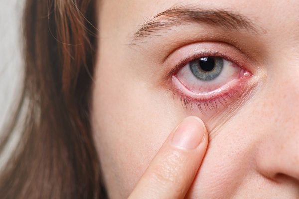 Đau mắt hột có lây không theo bác sĩ nhãn khoa là có thể lây truyền qua tiếp xúc với dịch từ mắt, đồ dùng cá nhân của người bệnh
