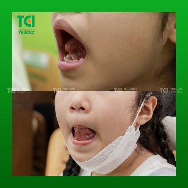 dính thắng lưỡi ở trẻ