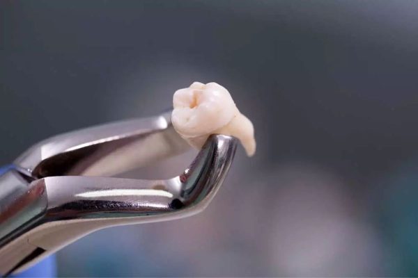 Nhổ răng khôn bằng kìm là phương pháp truyền thống, chi phí ít nhưng tồn tại nhiều rủi ro