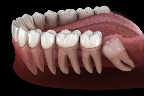 Răng khôn mọc khi mọi người đã đến tuổi trưởng thành, thường gặp phải tình trạng mọc ngầm, mọc lệch