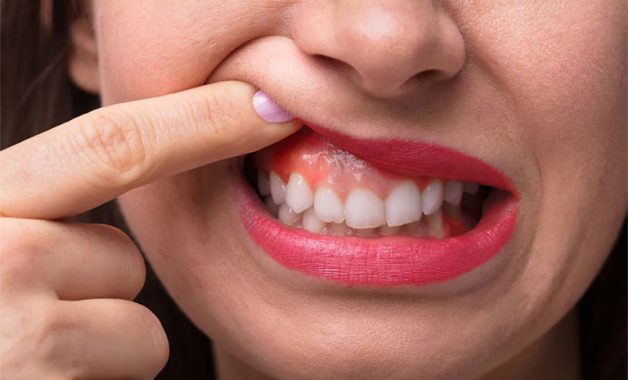 Không sâu răng vẫn hôi miệng vì viêm nướu cũng có thể gây hôi miệng