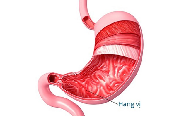 Loét hang vị là bệnh lý phổ biến ở hệ tiêu hóa