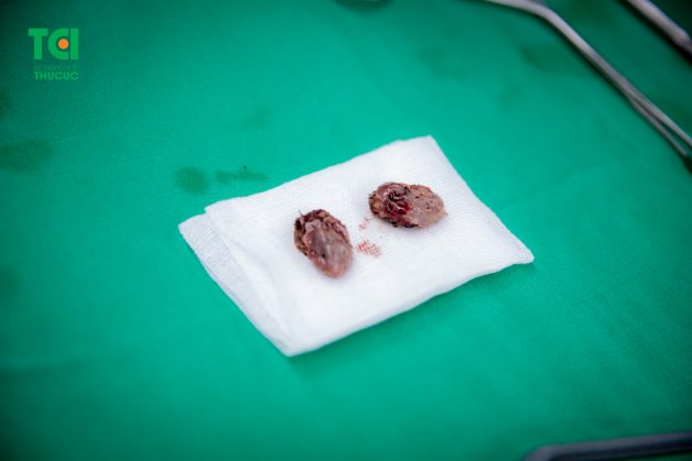 Nhiều bệnh nhân viêm Amidan đã được Thu Cúc TCI điều trị thành công