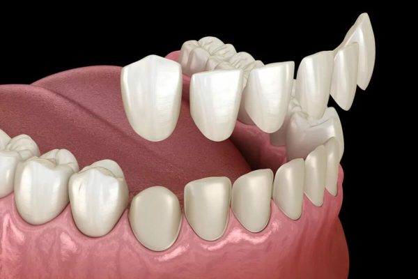 Dán sứ veneer đảm bảo thẩm mỹ nhưng vẫn bảo toàn tối đa các mô răng thật