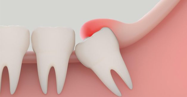 răng khôn bị lợi trùm
