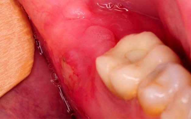 răng khôn bị lợi trùm