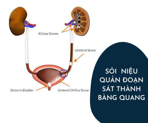 Tìm hiểu về sỏi niệu quản nội thành bàng quang
