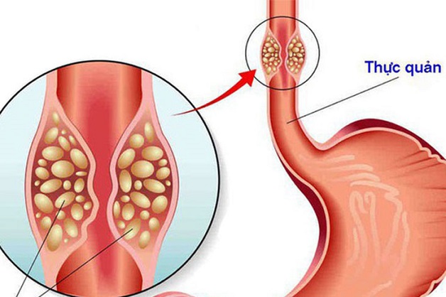 biến chứng của trào ngược dạ dày độ b