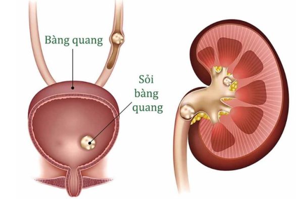 biểu hiện của sỏi bàng quang