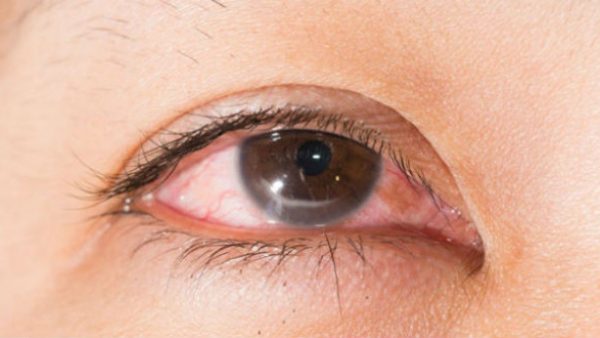viêm giác mạc sợi