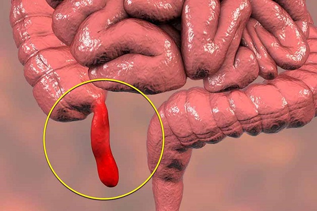 bệnh viêm ruột thừa ở trẻ em là gì