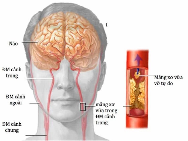 xơ vữa động mạch gây tai biến mạch máu não