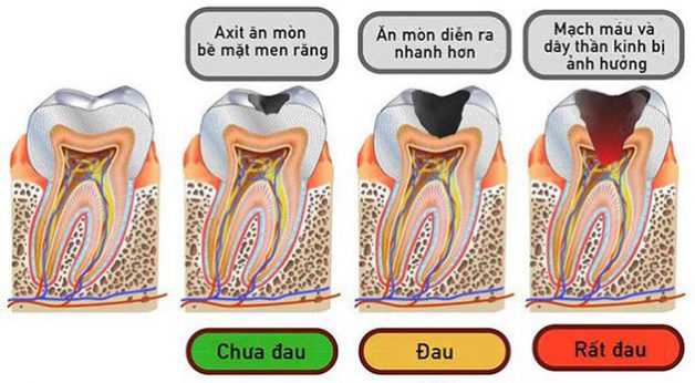 cách ngừa sâu răng