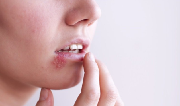 Những mụn rộp li ti tập trung thành từng mảng trên môi và xung quanh miệng là biểu hiện của Herpes môi