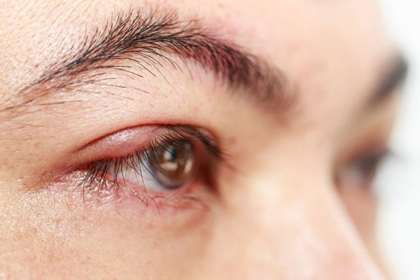 Sưng tấy, đau rát mí mắt là dấu hiệu thường thấy ở những người mắc viêm bờ mi