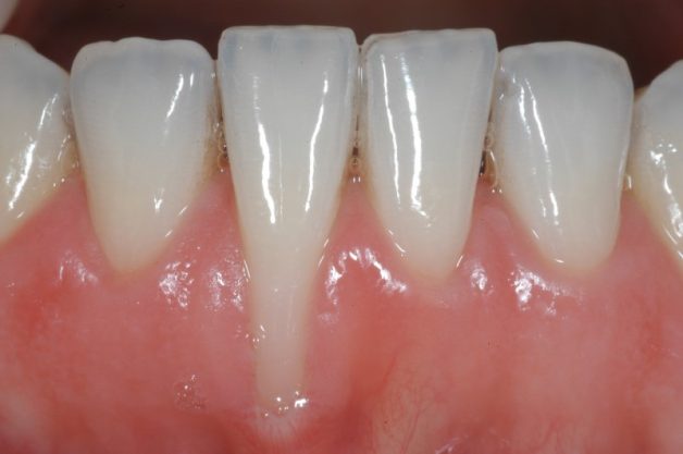 Tụt nướu là một dấu hiệu nhận biết viêm chân răng