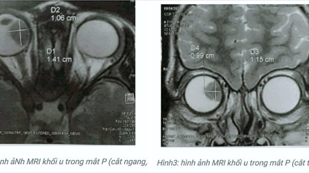 khám u nguyên bào võng mạc