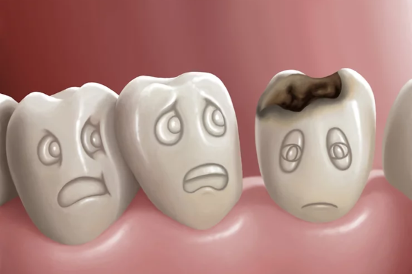 Sâu răng là tình trạng tổ chức răng bị tổn thương do quá trình hủy khoáng vi khuẩn gây ra