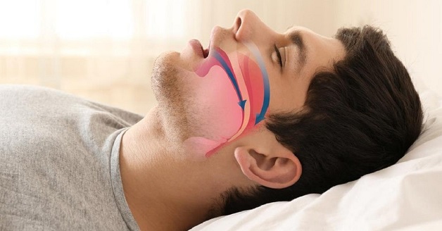 trị mất ngủ do ngưng thở khi ngủ 