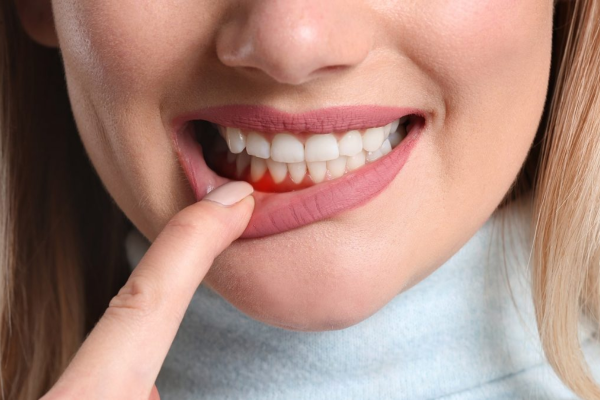 Viêm lợi thường xảy ra khi vi khuẩn tấn công quá mức gây sưng tấy, đau nhức vùng nướu răng
