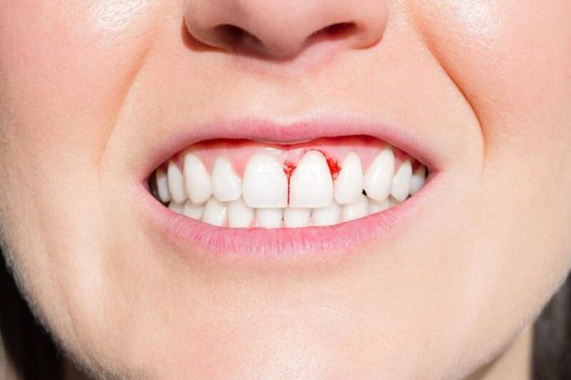 Chảy máu chân răng là biểu hiện đặc trưng của viêm nướu răng