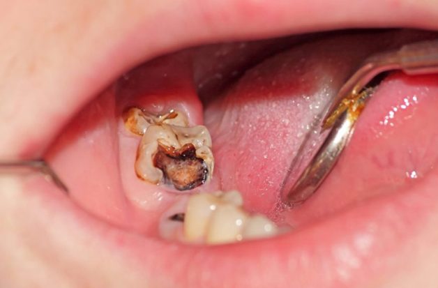 Chấn thương răng, sâu răng hoặc viêm quanh răng không được giải quyết triệt để đều có thể dẫn đến tình trạng viêm tủy răng