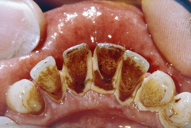 Cao răng huyết thanh là cao răng thường thấm đẫm máu và dịch viêm của lợi