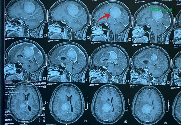 Đau đầu trong u não như có vật gì đó đè nặng