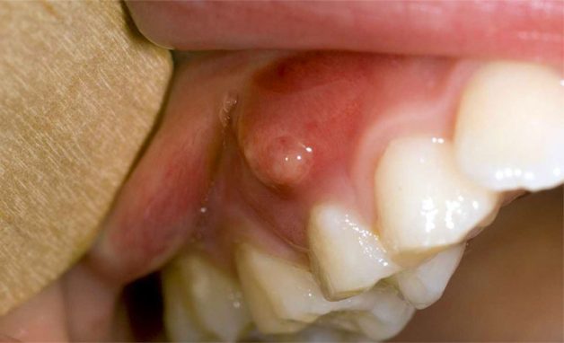 dấu hiệu bị viêm lợi