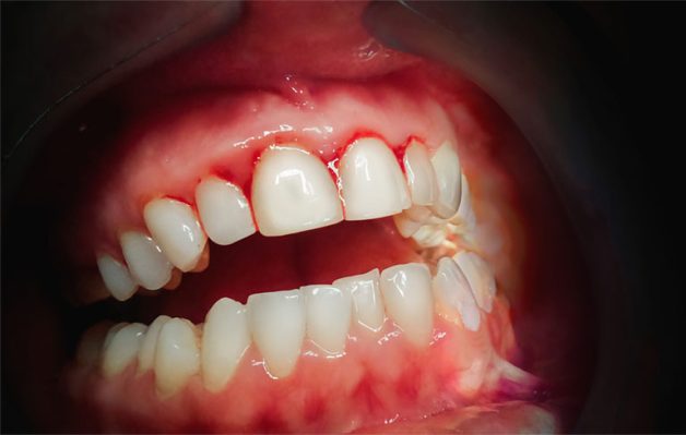 Viêm chân răng có thể được nhận biết qua triệu chứng chảy máu lợi