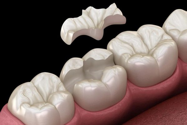 Miếng trám không khớp tạo ra khe rỗng, tăng áp suất tới cầu trúc răng và tác động tới ống ngà