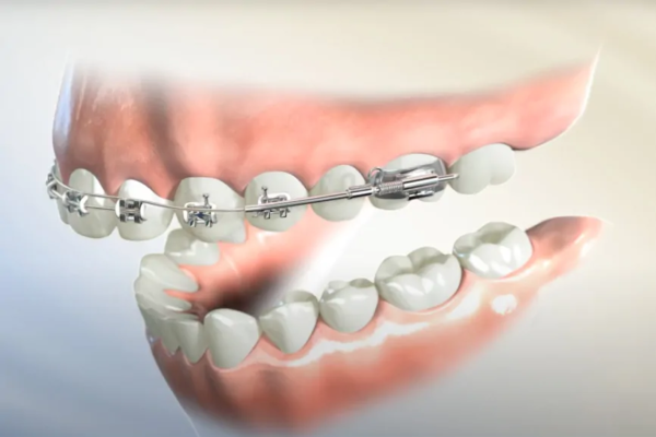 Khắc phục cười hở lợi không phẫu thuật bằng việc niềng răng kết hợp đánh lún răng