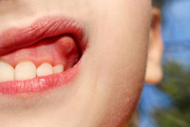 Nang thân răng là một loại khối u xương hàm lành tính