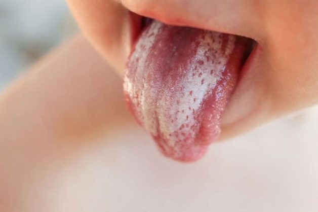Ở giai đoạn đầu, nấm miệng không có biểu hiện bất thường