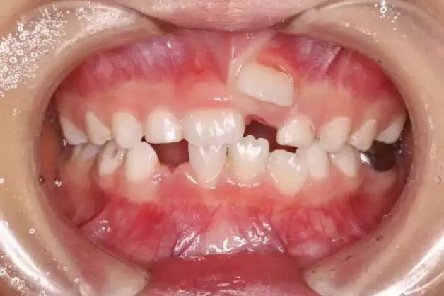 nắn chỉnh răng cho trẻ em